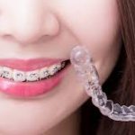 Invisalign: Uniting Aesthetic Brilliance with Oral Health Excellence